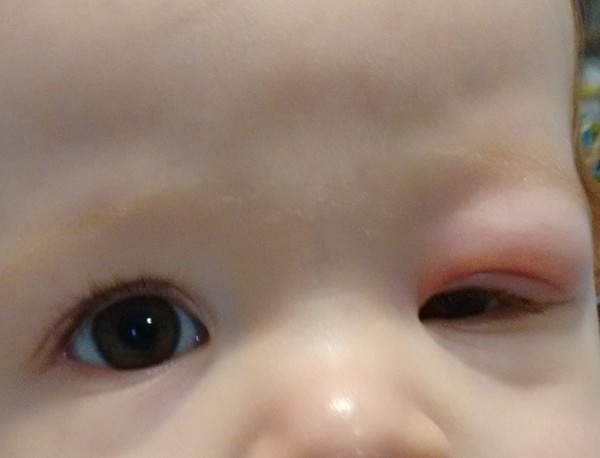 Useless Doctors, please help!! 7 week baby’s eye!!
