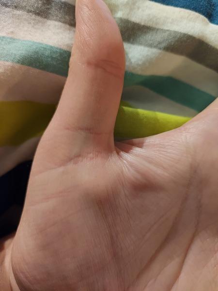 What is this lump on my hand?