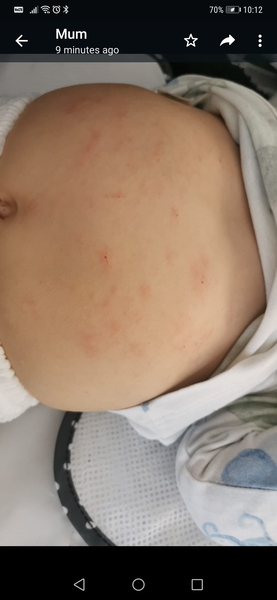 Rash on tummy