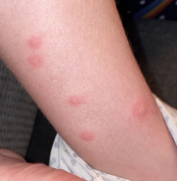 Bites on dd