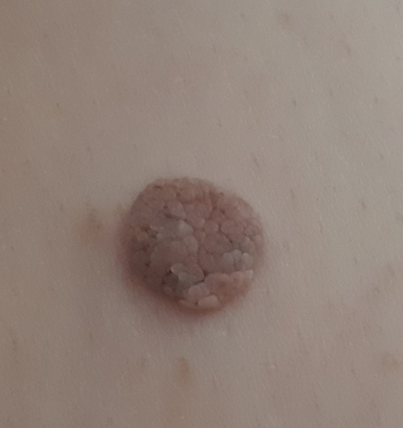 Is this a mole or a skin tag? (Photo attached).