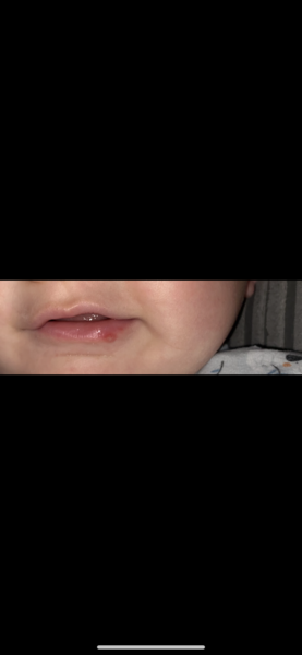 Is this a cold sore?