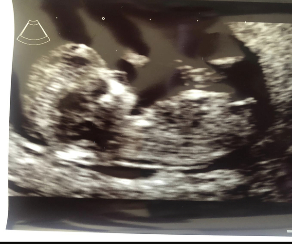 12 Week Scan Sex Predictions