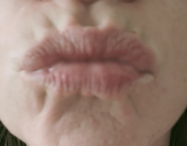 Lip Fillers (for 'smokers' lines)