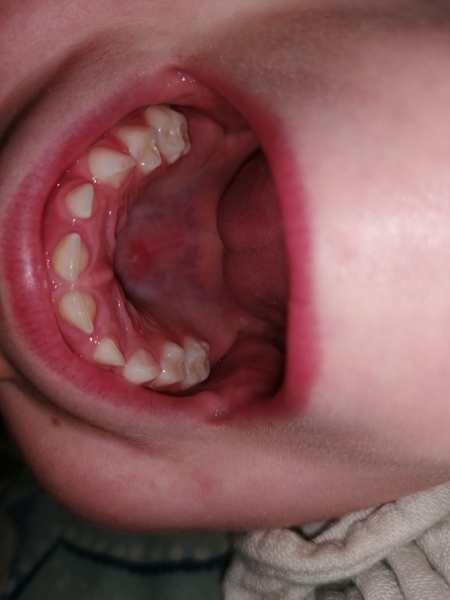 Sore on roof of mouth, doc or dentist?