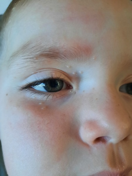 *Pic included* - what are these spots on 3yo face?