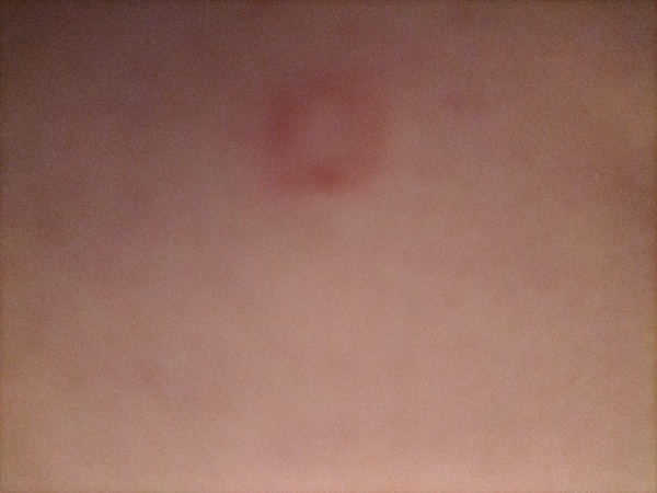 Ringworm/psoriasis/Lyme Disease? WARNING PIC ATTACHED