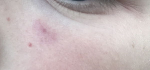 Opinions on a mark on face that won’t go