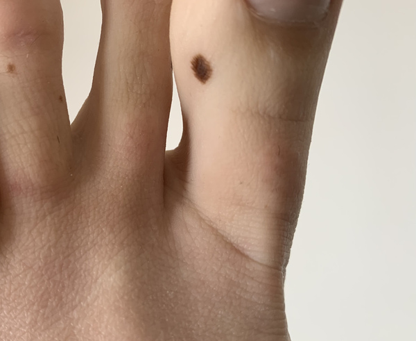 Dodgy mole??
