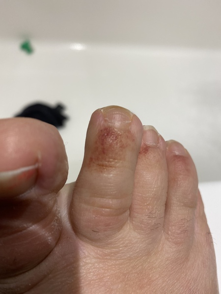 Strange bruising/redness with dots (picture)