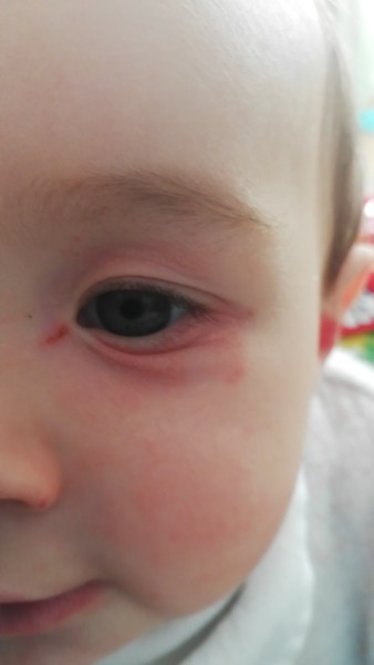 Allergy?