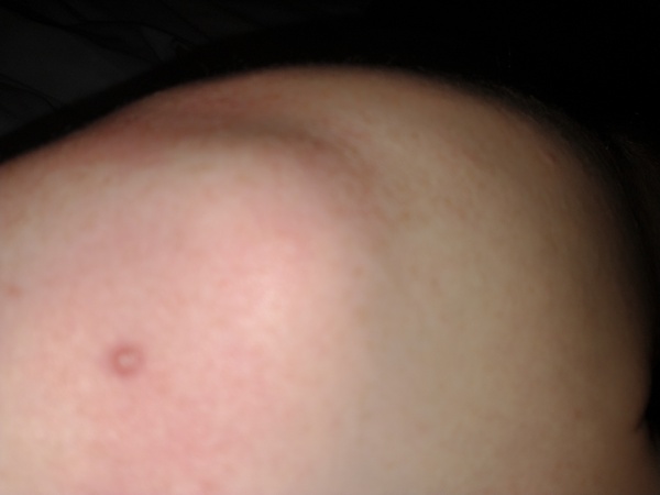 Weird rash - any ideas?