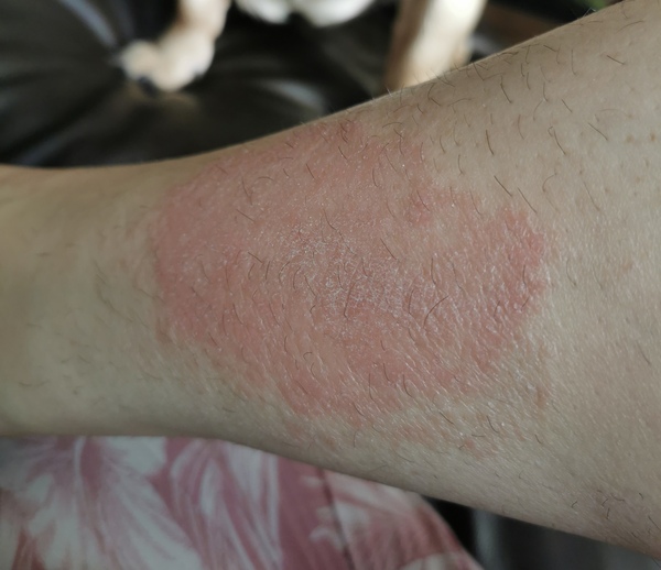Is this psoriasis? Help!