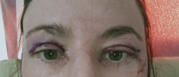 If you had an Upper Blepharoplasty