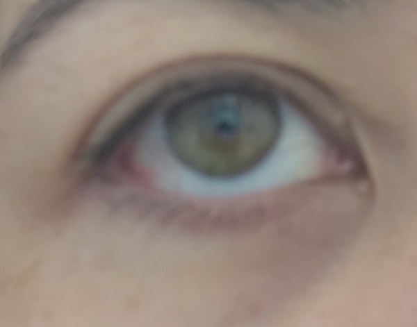 Skin Tags on Eyes