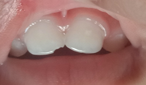 My baby fell while walking and chipped his front teeth. I m worried