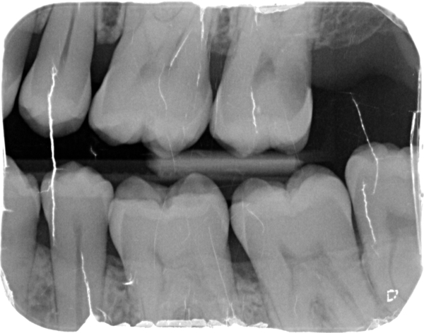 To be a bit upset and surprised I need 3 teeth out?