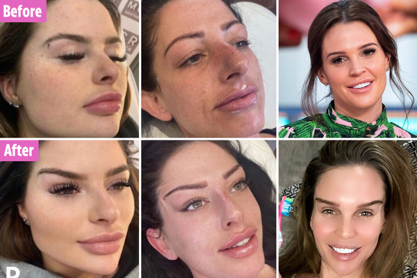 To think that the trend for buccal fat removal is worse than filler