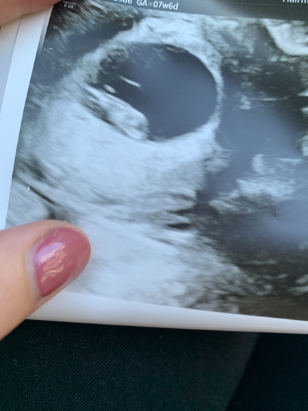 Anyone else 5 weeks pregnant?