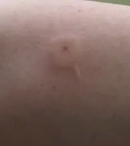 Spider bite or drama queen??