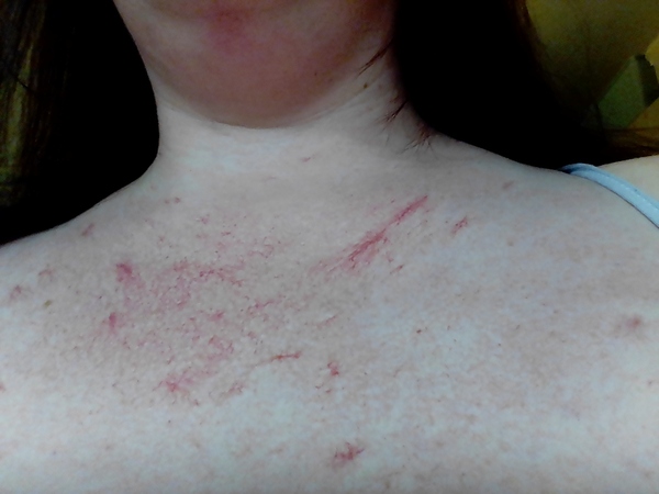 Can you help me identify this skin condition?