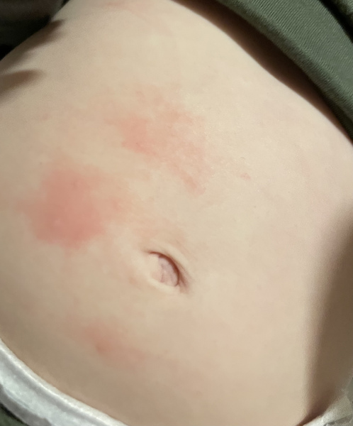 Stings/bites on 1year old?