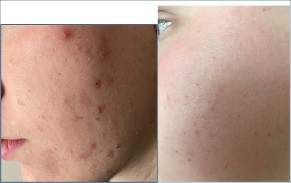 Teenage Acne - what can the GP do?