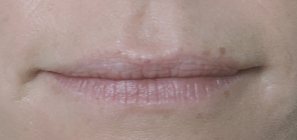 Lip Fillers (for 'smokers' lines)
