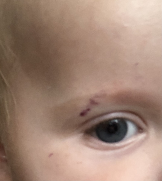 How to un-purple a 6 month old?