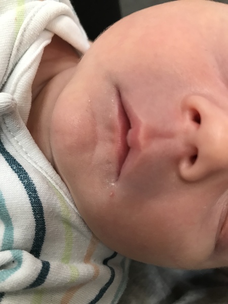 Spot or cold sore on newborn?