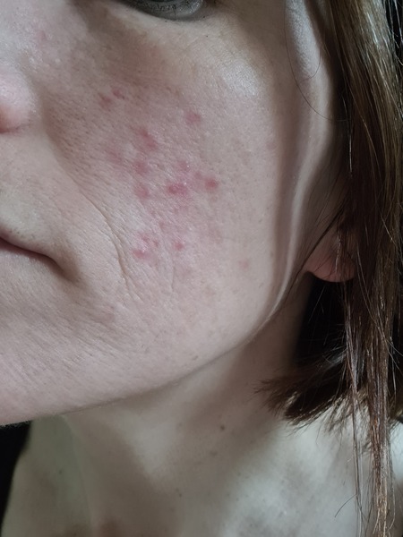 Spots on cheeks, low libido etc - hormones?