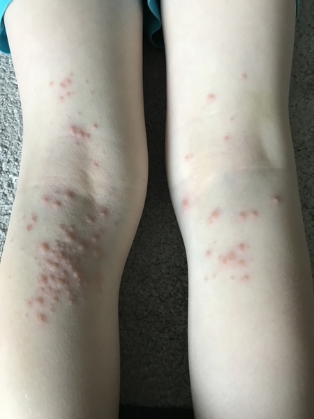 Does anyone know what this rash is?