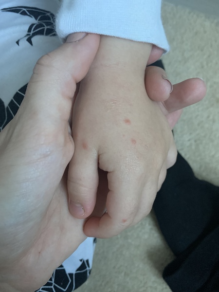 Does this look like chicken pox?
