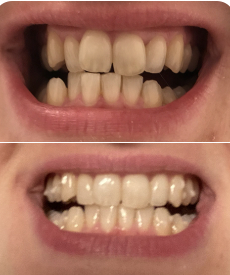 Anyone used Invisalign