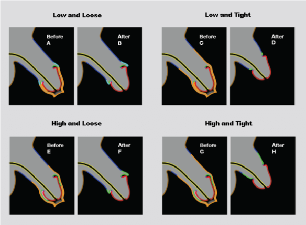 Abigail Shrier - Marci Bowers - critical of puberty blockers
