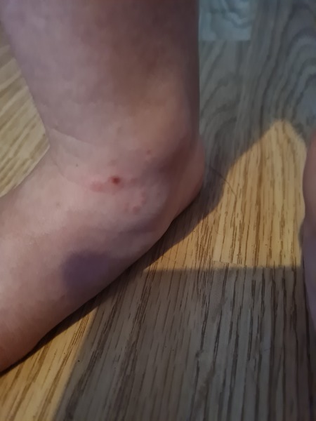 Rash with diarrhea