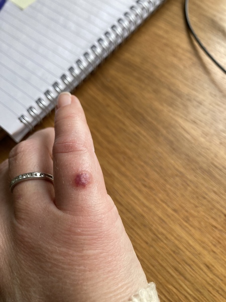 What has bitten me and what to do about it?