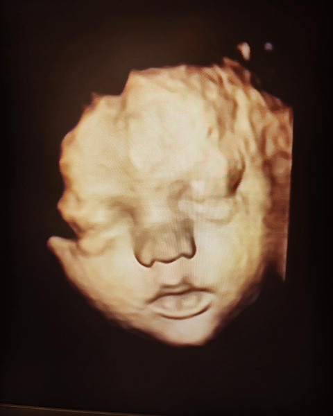 NT thickness, is there hope for us