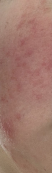 I think I have Rosacea - can anyone give me some good skincare recommendations?