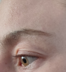 If you had an Upper Blepharoplasty