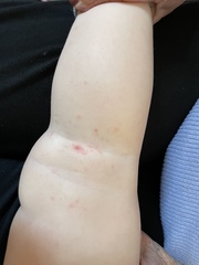 Another chicken pox/hfm (with pics)