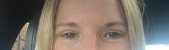 If you had an Upper Blepharoplasty