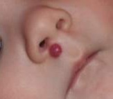 Hemangioma