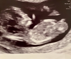 Nub theory - sex of the baby guesses?