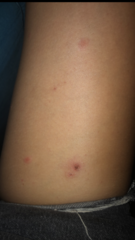 Ringworm exposure