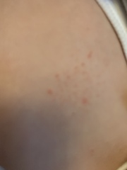 Dr says rash is just viral but not sure.. (pic)