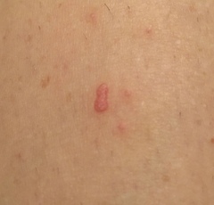 What do these bumps look like? Pic included