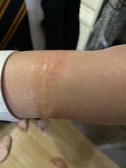 How to treat this?