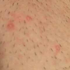 What do these bumps look like? Pic included