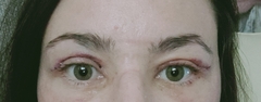 If you had an Upper Blepharoplasty
